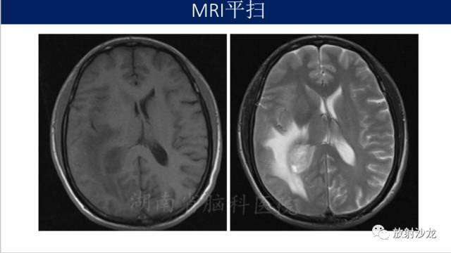 【病例】胶质母细胞瘤1例MR影像表现