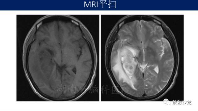 【病例】胶质母细胞瘤1例MR影像表现