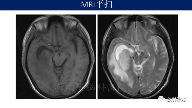 【病例】胶质母细胞瘤1例MR影像表现