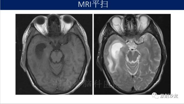 【病例】胶质母细胞瘤1例MR影像表现