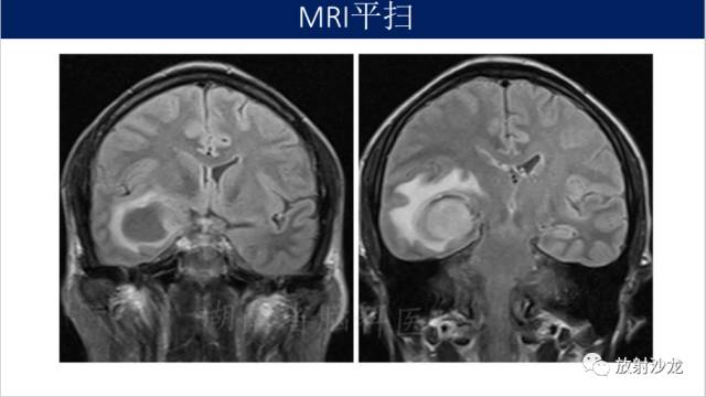 【病例】胶质母细胞瘤1例MR影像表现