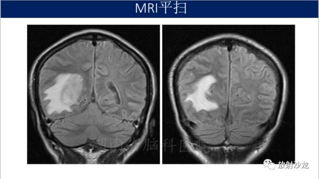【病例】胶质母细胞瘤1例MR影像表现