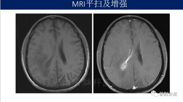 【病例】胶质母细胞瘤1例MR影像表现
