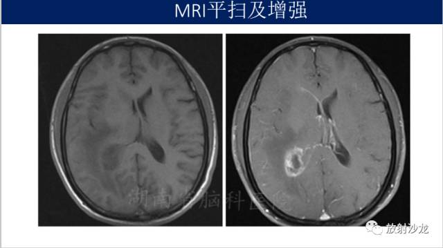 【病例】胶质母细胞瘤1例MR影像表现