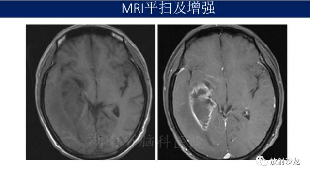 【病例】胶质母细胞瘤1例MR影像表现