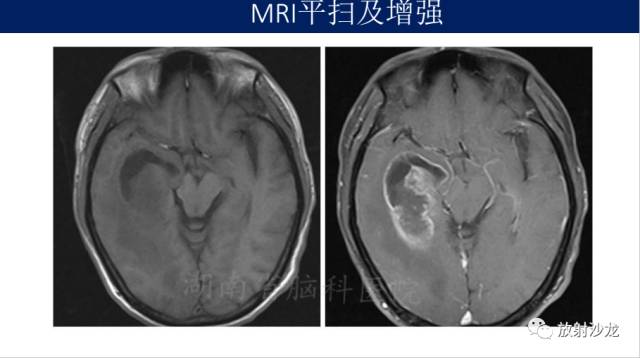 【病例】胶质母细胞瘤1例MR影像表现