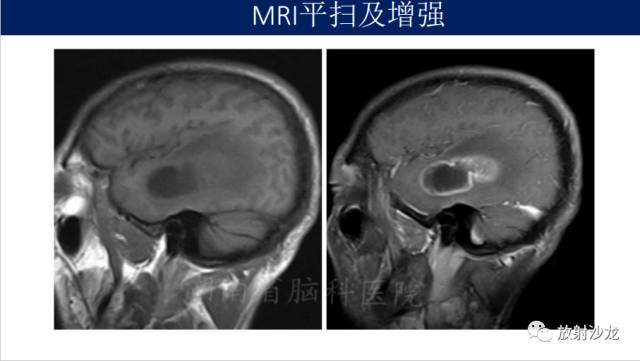 【病例】胶质母细胞瘤1例MR影像表现