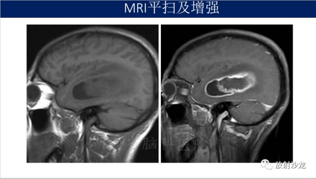 【病例】胶质母细胞瘤1例MR影像表现