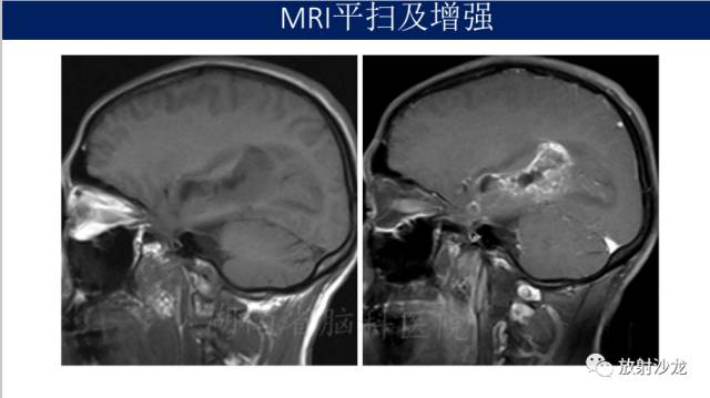 【病例】胶质母细胞瘤1例MR影像表现