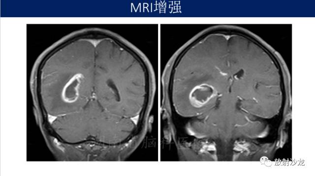 【病例】胶质母细胞瘤1例MR影像表现