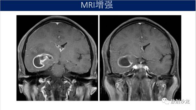 【病例】胶质母细胞瘤1例MR影像表现