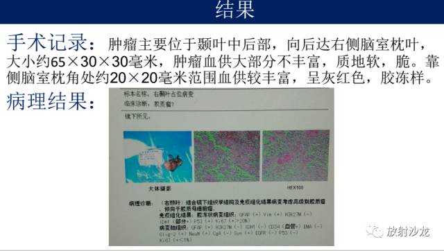 【病例】胶质母细胞瘤1例MR影像表现