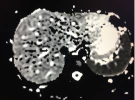 【病例】肝脏局灶性结节增生1例CT及MR影像表现 【病例】肝脏局灶性结节增生1例CT及MR影像表现