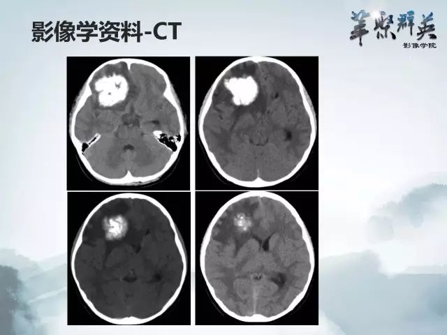 【病例】右额叶室管膜瘤伴团块状钙化1例CT及MR