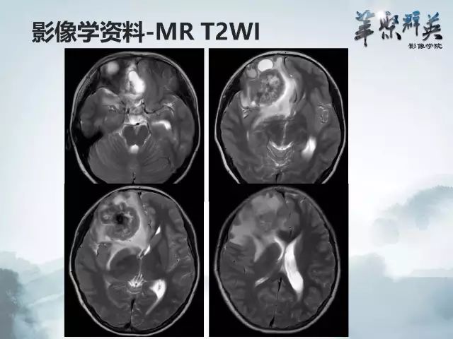 【病例】右额叶室管膜瘤伴团块状钙化1例CT及MR