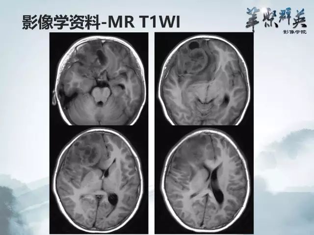 【病例】右额叶室管膜瘤伴团块状钙化1例CT及MR