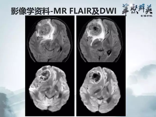 【病例】右额叶室管膜瘤伴团块状钙化1例CT及MR