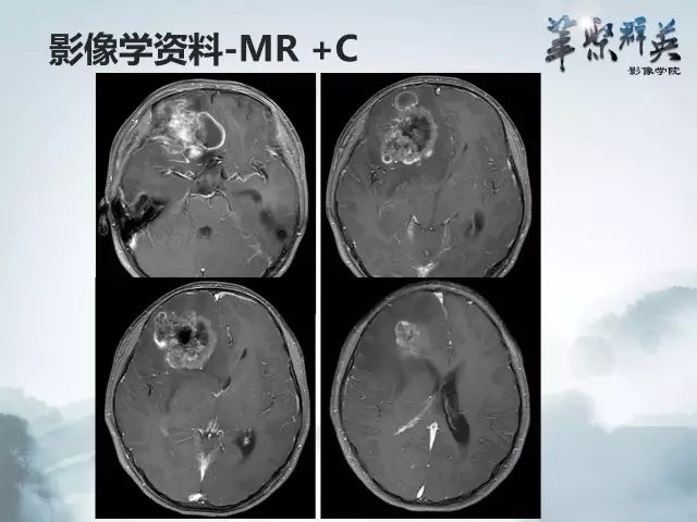 【病例】右额叶室管膜瘤伴团块状钙化1例CT及MR