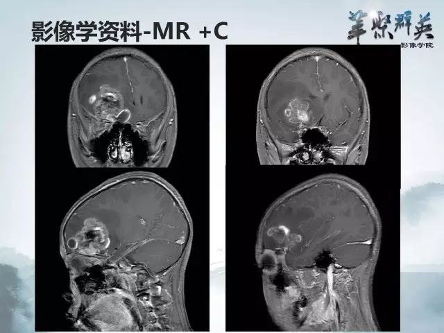 【病例】右额叶室管膜瘤伴团块状钙化1例CT及MR