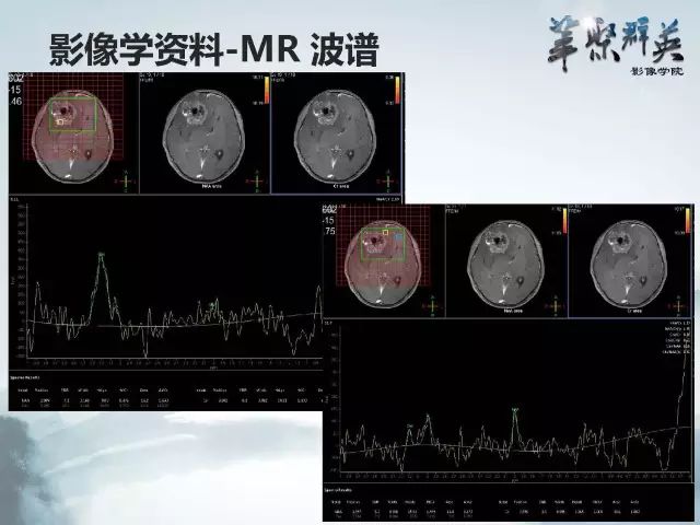 【病例】右额叶室管膜瘤伴团块状钙化1例CT及MR