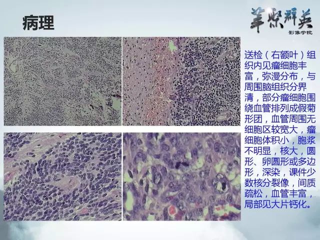 【病例】右额叶室管膜瘤伴团块状钙化1例CT及MR