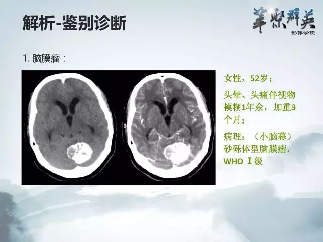 【病例】右额叶室管膜瘤伴团块状钙化1例CT及MR