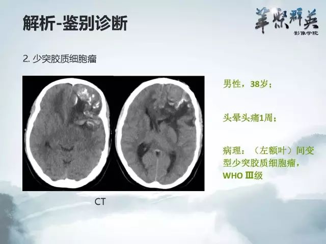 【病例】右额叶室管膜瘤伴团块状钙化1例CT及MR