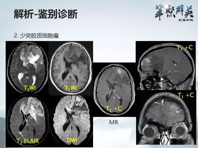 【病例】右额叶室管膜瘤伴团块状钙化1例CT及MR