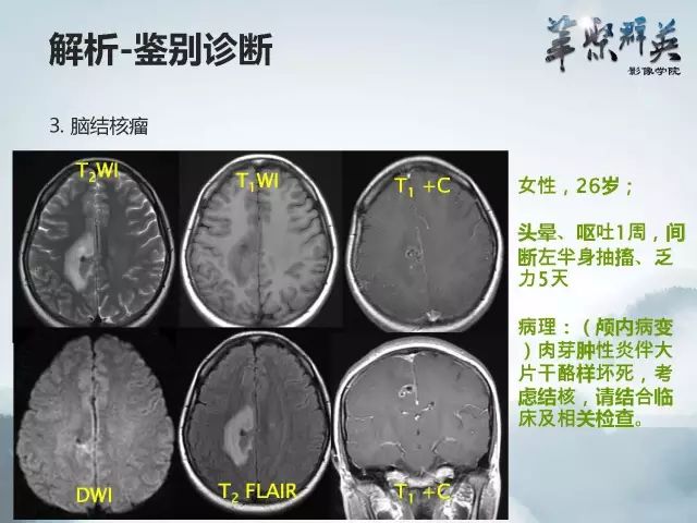 【病例】右额叶室管膜瘤伴团块状钙化1例CT及MR