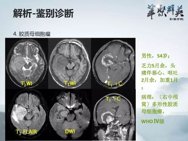 【病例】右额叶室管膜瘤伴团块状钙化1例CT及MR