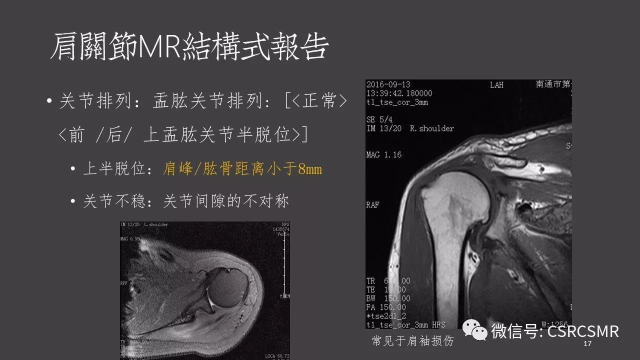【PPT】肩关节MRI的结构式评估