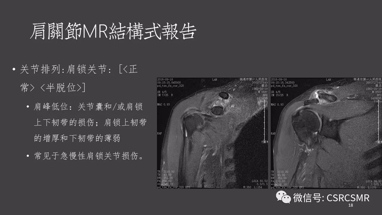 【PPT】肩关节MRI的结构式评估