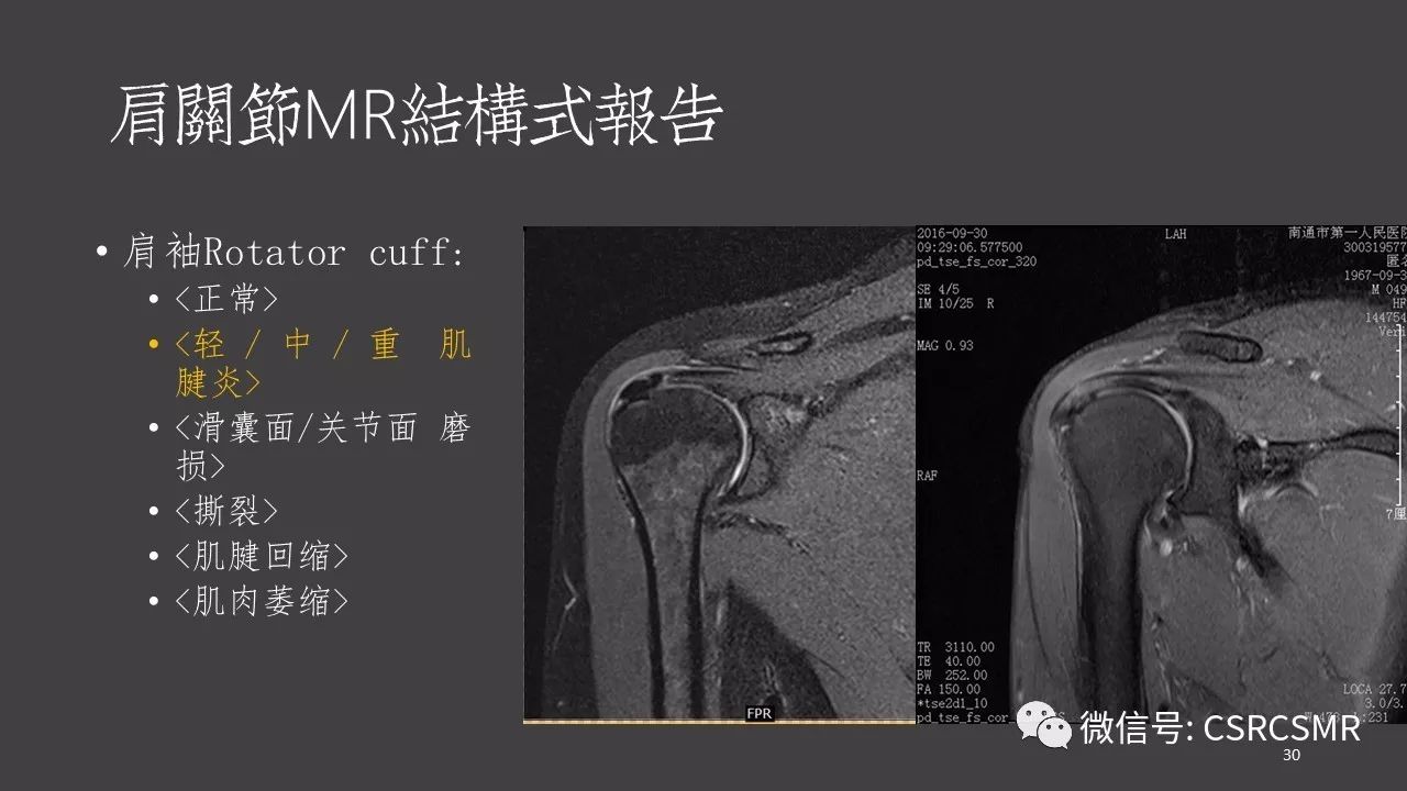 【PPT】肩关节MRI的结构式评估