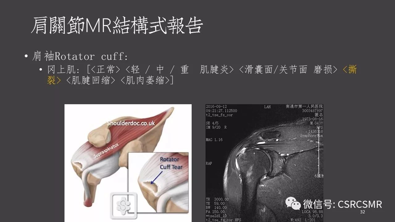 【PPT】肩关节MRI的结构式评估