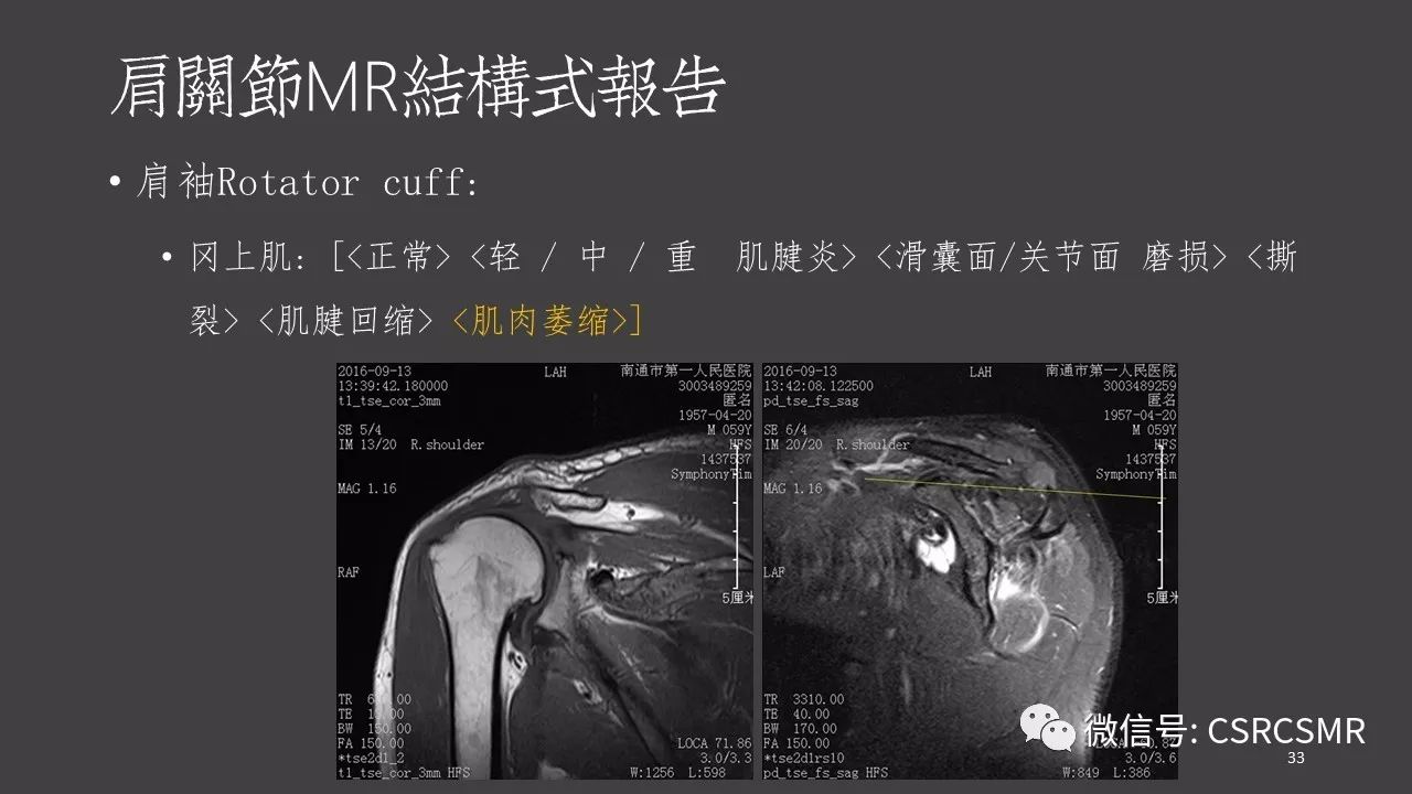 【PPT】肩关节MRI的结构式评估