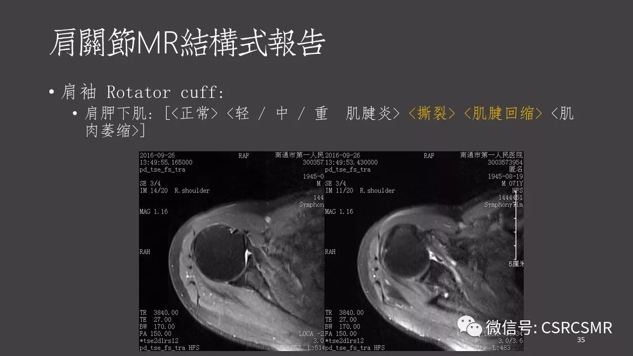 【PPT】肩关节MRI的结构式评估