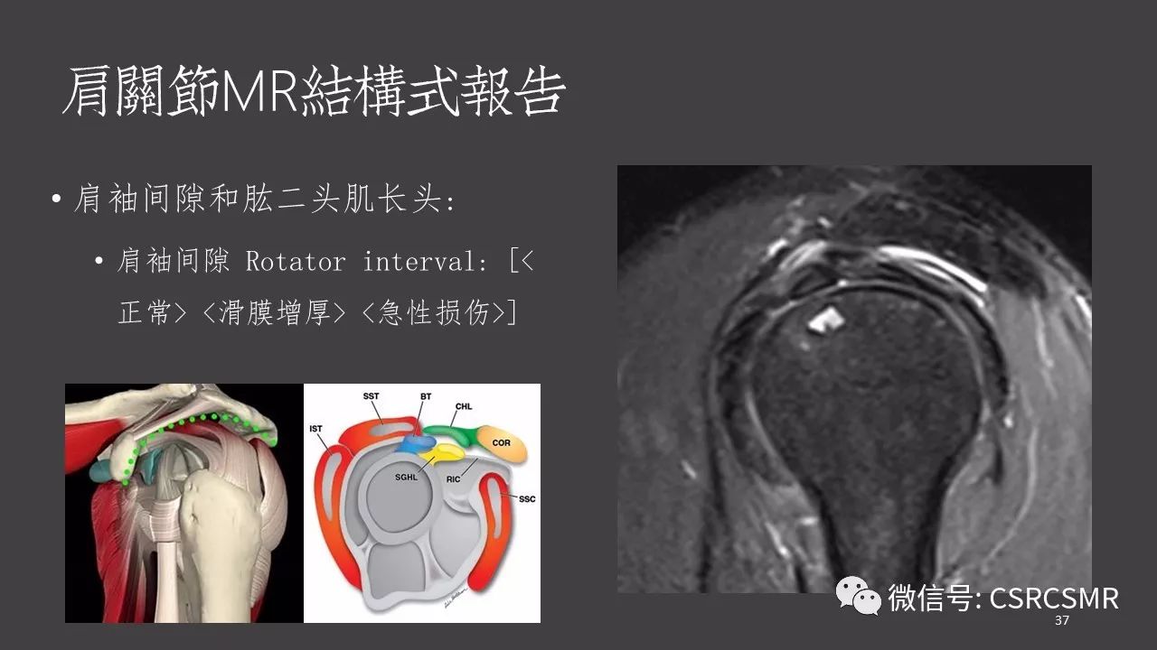 【PPT】肩关节MRI的结构式评估