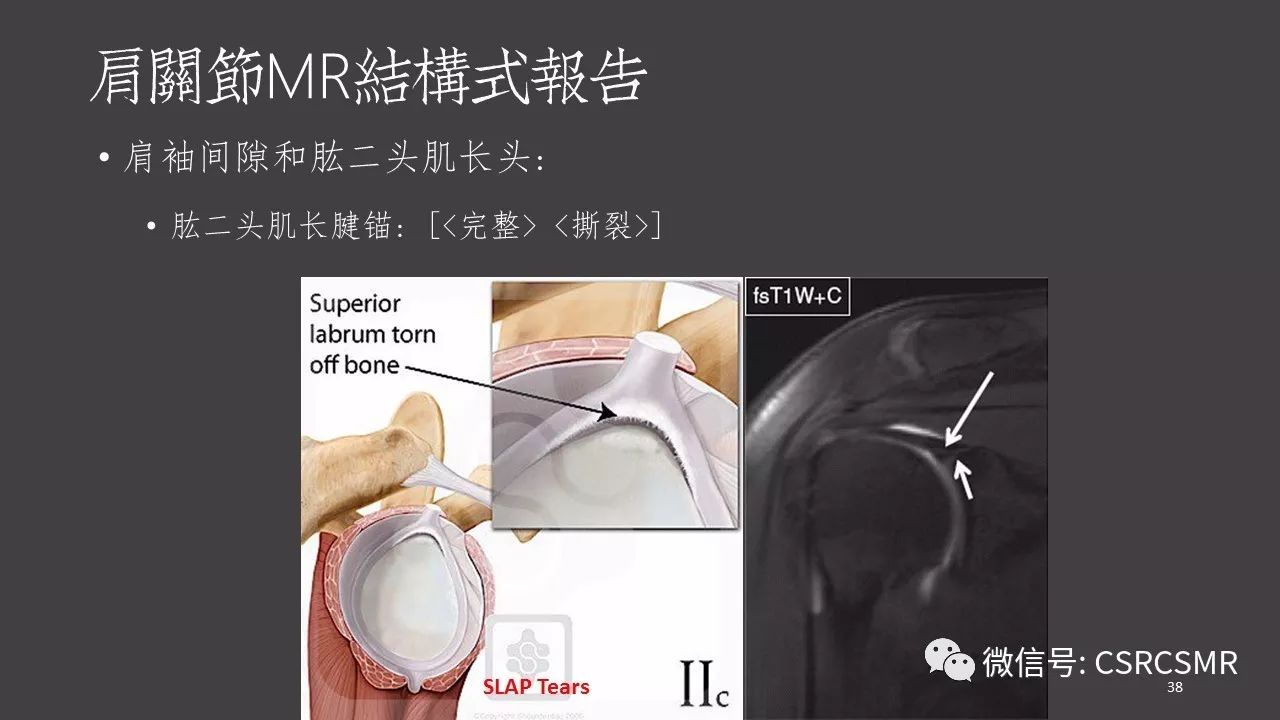 【PPT】肩关节MRI的结构式评估