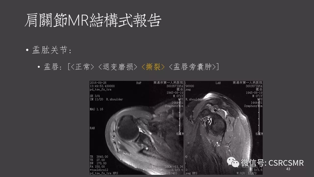 【PPT】肩关节MRI的结构式评估