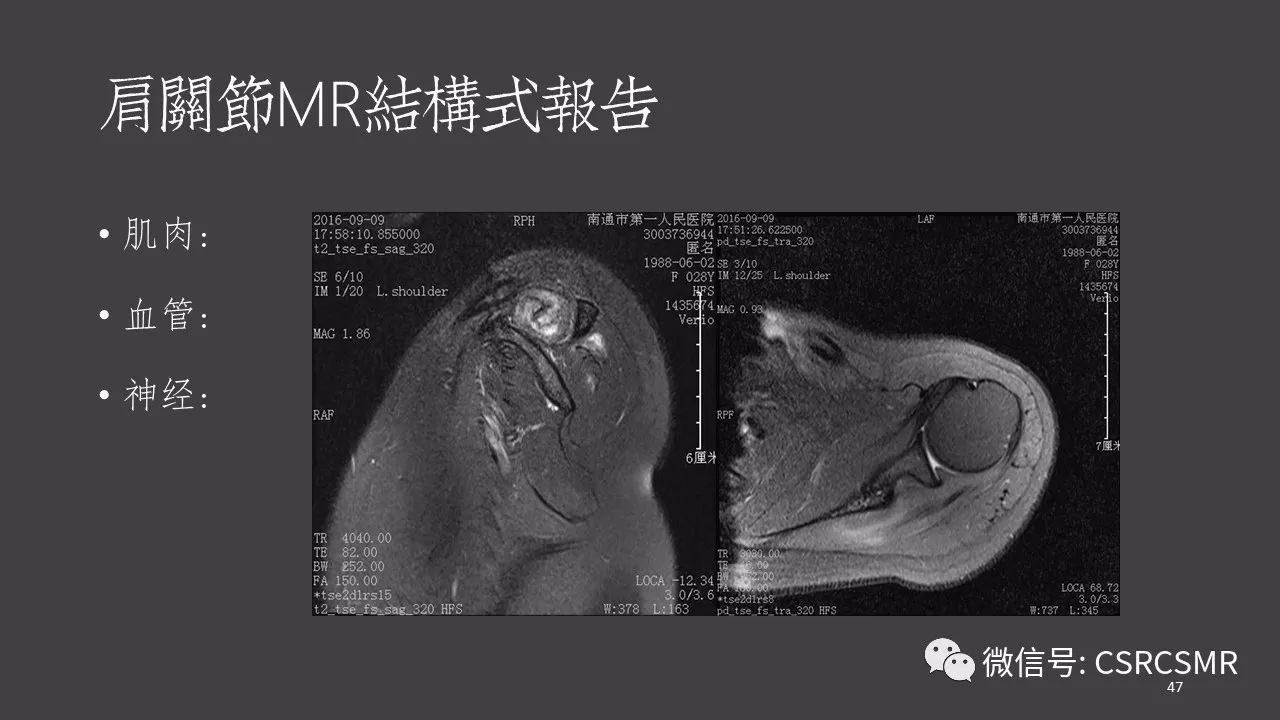 【PPT】肩关节MRI的结构式评估