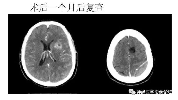 【病例】左额叶胶质母细胞瘤1例MR