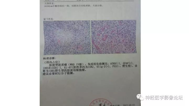 【病例】左额叶胶质母细胞瘤1例MR