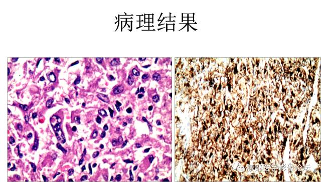 【病例】左肝上皮样血管平滑肌脂肪瘤1例MR 【病例】左肝上皮样血管平滑肌脂肪瘤1例MR