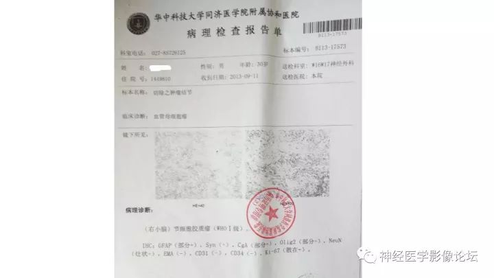 【病例】小脑节细胞胶质瘤1例MR