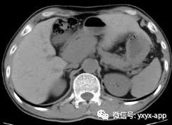 【病例】肝外型门静脉瘤1例CT影像表现 【病例】肝外型门静脉瘤1例CT影像表现