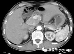 【病例】肝外型门静脉瘤1例CT影像表现 【病例】肝外型门静脉瘤1例CT影像表现