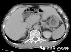 【病例】肝外型门静脉瘤1例CT影像表现 【病例】肝外型门静脉瘤1例CT影像表现
