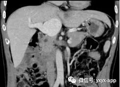 【病例】肝外型门静脉瘤1例CT影像表现 【病例】肝外型门静脉瘤1例CT影像表现