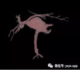 【病例】肝外型门静脉瘤1例CT影像表现 【病例】肝外型门静脉瘤1例CT影像表现
