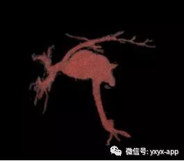 【病例】肝外型门静脉瘤1例CT影像表现 【病例】肝外型门静脉瘤1例CT影像表现